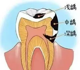 10个孩子7个龋！小蛀牙，大危害 学好4大护牙法!!